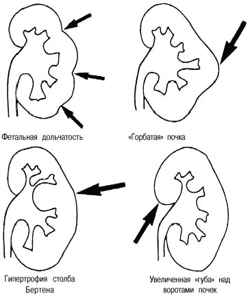 Односторонняя аплазия почки. Гипертрофия почки что это. Викарно увеличенная почка. Компенсаторная гипертрофия почки. Агенезия и аплазия почки.