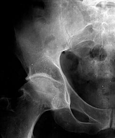 Изображение - Рентген деформирующего артроза тазобедренного сустава p2941