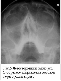пазуха секрет. функции пазух носа. затемнение на рентгене носовых пазух. пазуха секрет. одонтогенный гайморит рентген.