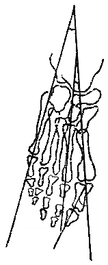 Схема определения углов поперечного свода стопы