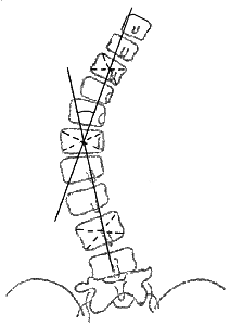 Измерение угла сколиотической дуги по методу Фергюссона