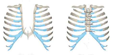 Неосложненный перелом ребра. Остеосинтез при переломе ребер. Сшивание грудины рентген. Сколько срастается грудина после операции. Срединная продольная стернотомия.